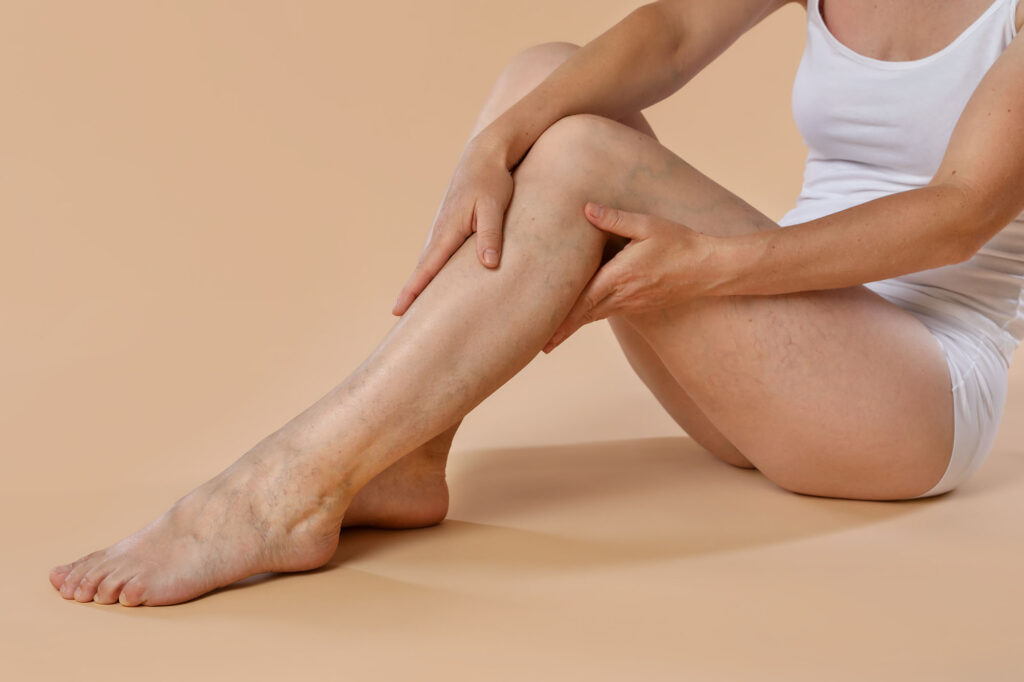 femme avec douleurs de jambes